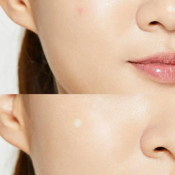 COSRX Acne Pimple Patch - JOLIE'S