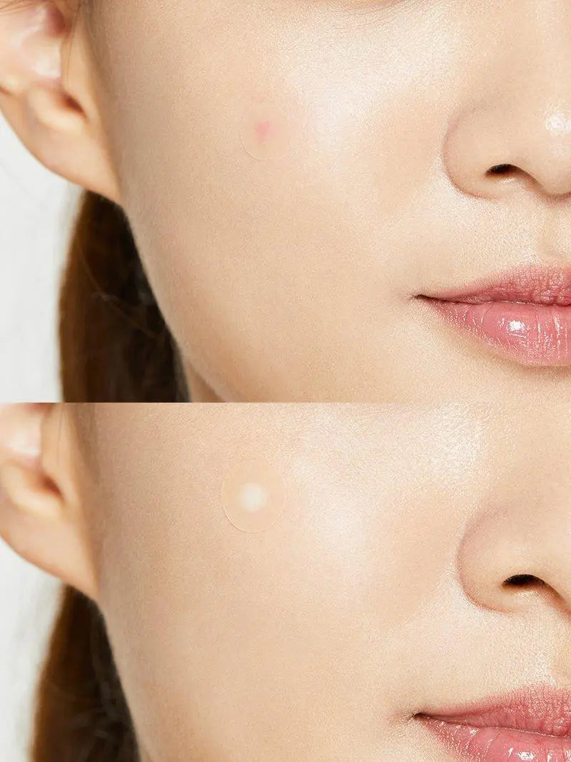 COSRX Acne Pimple Patch - JOLIE'S